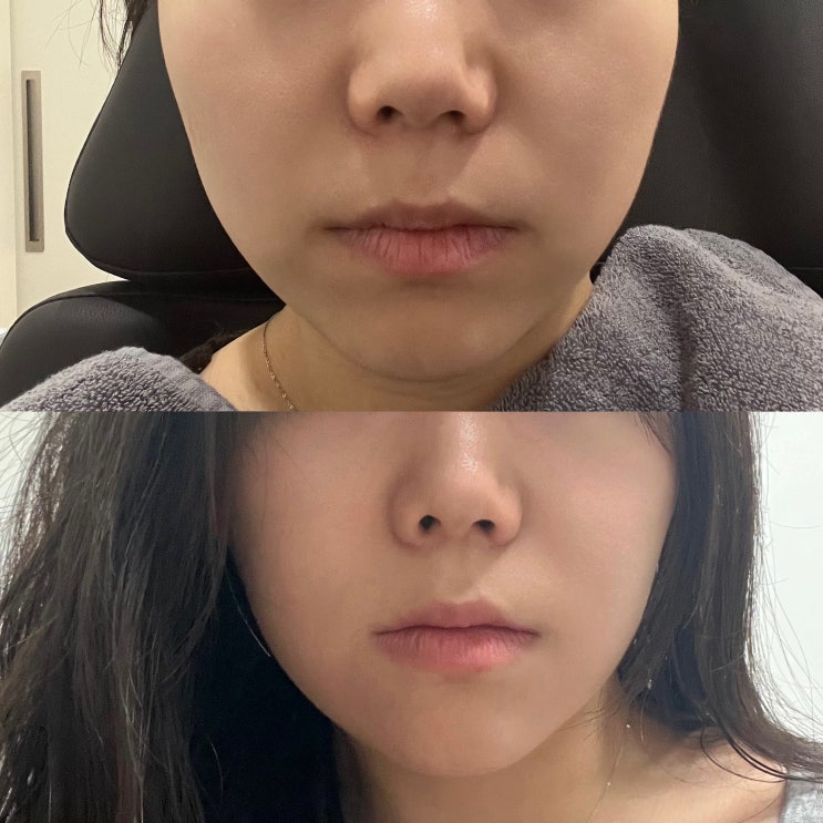  잠실 피부과 슈링크유니버스 300샷 솔직 후기 (심부볼, 팔자주름 효과, 슈링크 고통 등)