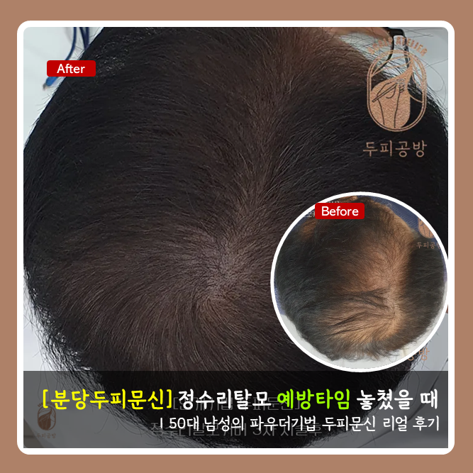 [분당두피문신] 파우더기법, 정수리 탈모 예방 골든타임 놓쳤을 때 최적의 솔루션