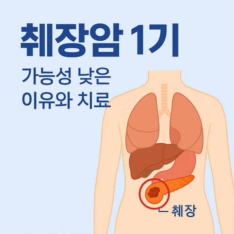 췌장암 1기 생존률 조기발견 가능성이 낮은 이유와 치료 방법 정리