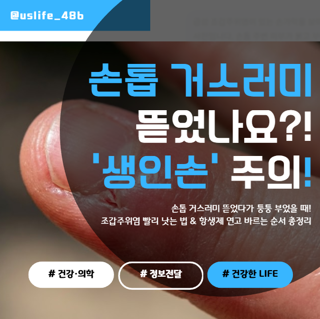 손톱 거스러미 뜯었다가 퉁퉁 부었을 때! 조갑주위염(생인손) 연고 추천 & 고름 배농 타이밍 (....