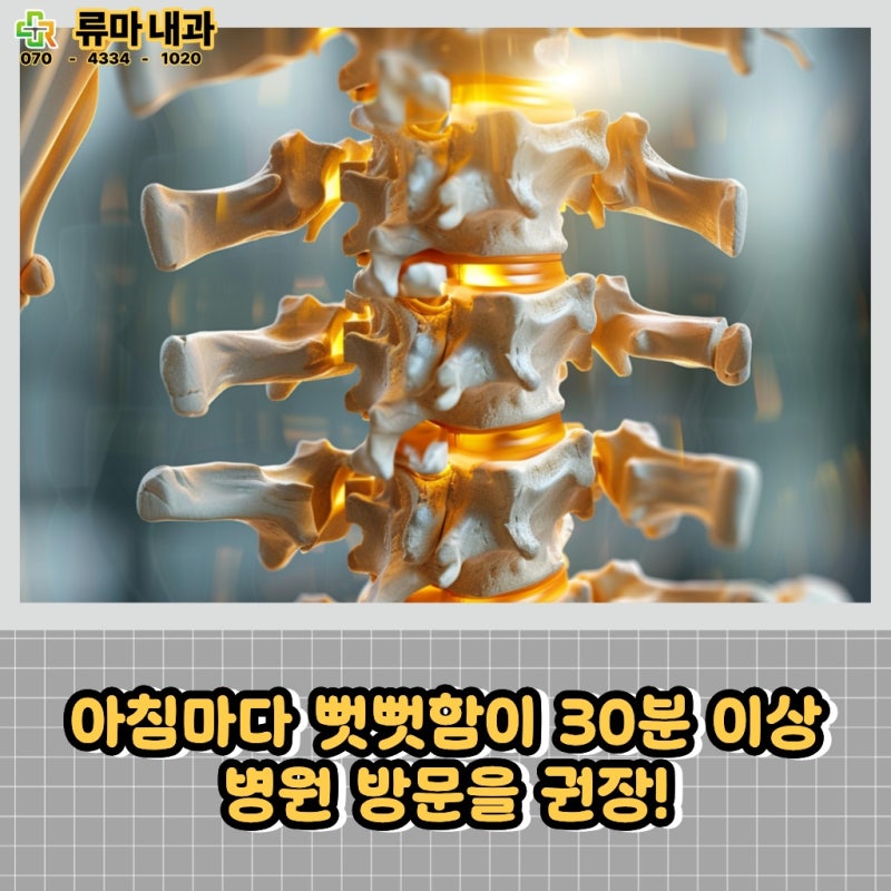 강직성 척추염 주사 치료는 어떤 경우에 고려할까요?