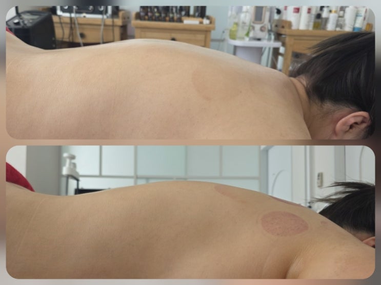  [명지]20년 경력의 원장님 시그니처 등관리는 명지피부관리 '화문에스테틱'