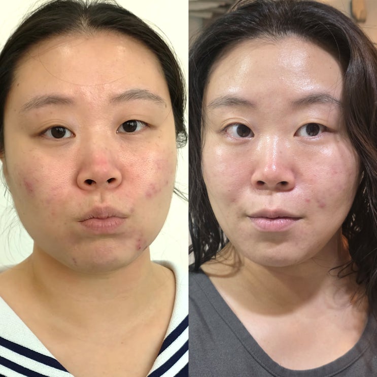  당신이 민감성피부를 벗어나지 못하는 이유, 피부장벽 강화하려면?