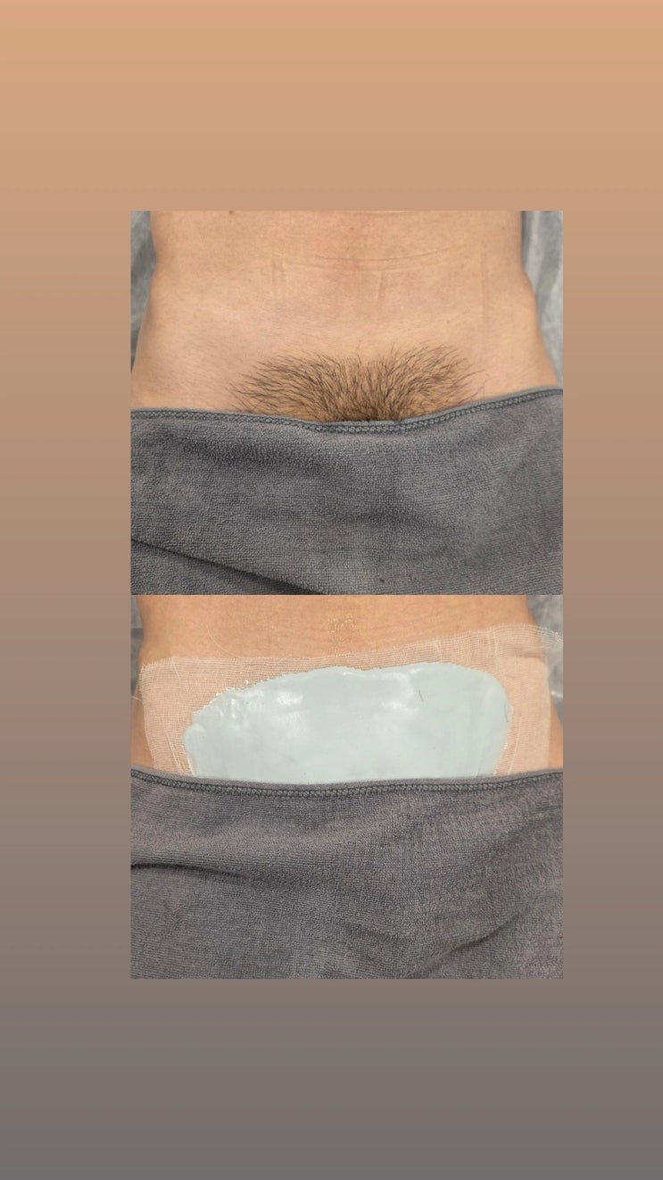  남자 브라질리언 왁싱을 남자 왁서가 케어하는 영등포 남자 왁싱샵 "청춘케어"