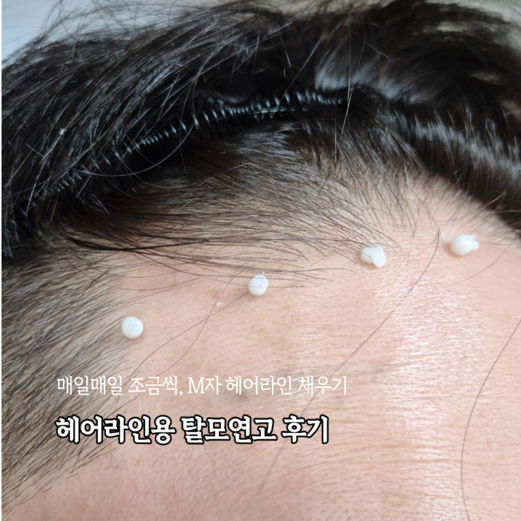  탈모예방해주는 이문원 탈모연고 M자 헤어라인에 사용해본 후기
