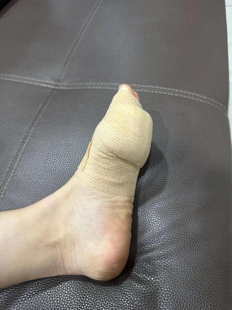 내 10년지기 티눈친구 bye 정형외과 티눈 제거 수술 후기