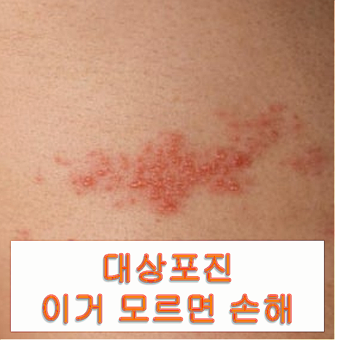  대상포진 초기 증상 병원 치료 전, 이렇게만 해도 통증 훨씬 줄어요!