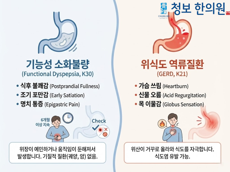  위내시경은 정상인데 속은 타들어간다? 약을 먹어도 재발하는 소화불량의 진짜 원인 (덕천동 위장치료)