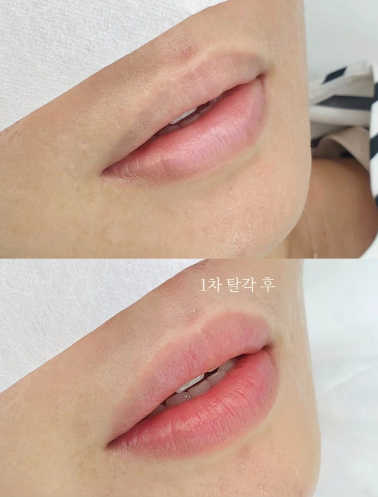  남자입술문신 어둡고 칙칙한 색 방치하지마세요