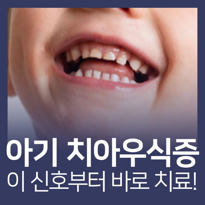 아기 치아우식증, 이 증상부터 바로 치료가 필요합니다