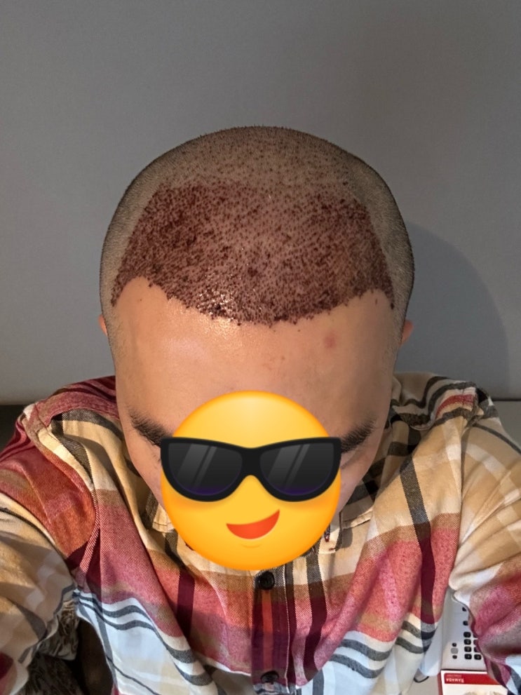  터키 모발이식 6개월차까지 후기 경과들입니다