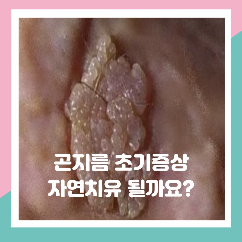 곤지름 초기증상 약물치료기간 자연소멸될까?