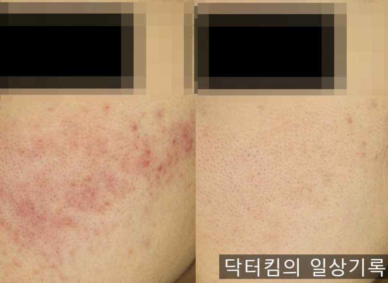 안면 홍조 주사피부염 레이저 치료 및 관리 방법 [by 피부과 전문의 닥터킴]