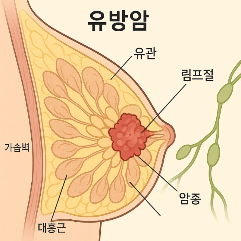 유방암4기 완치 생존율 뼈전이 의미