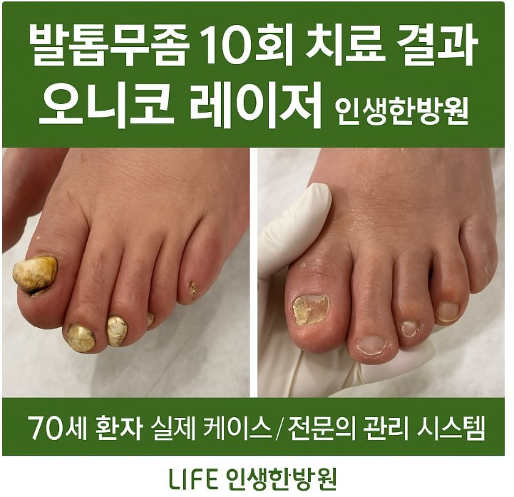 창원손발톱무좀 창원피부과 무좀한방 인생한방