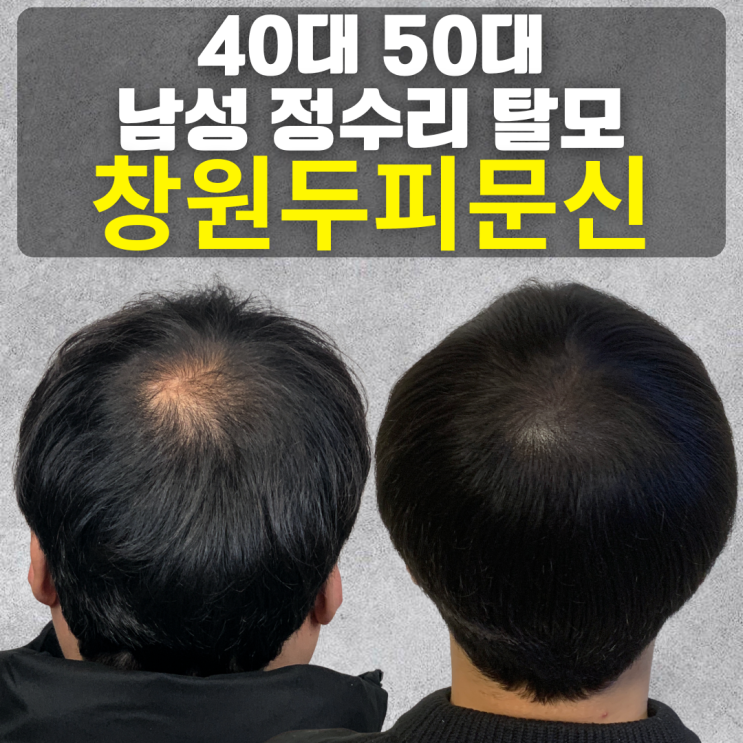  40대 50대 남성 정수리 탈모, 두피문신으로 해결 가능할까? (창원/경남)