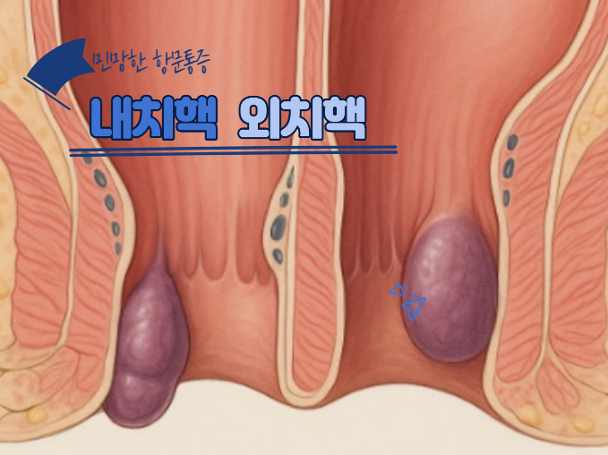  민망한 항문통증 치핵 증상 내치핵 외치핵 수술 자연치료 가능할까?