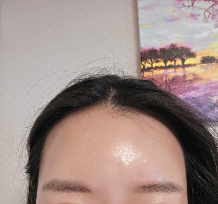  창원 이마필러 7cc후기 돌출형 눈, 붓기 변화