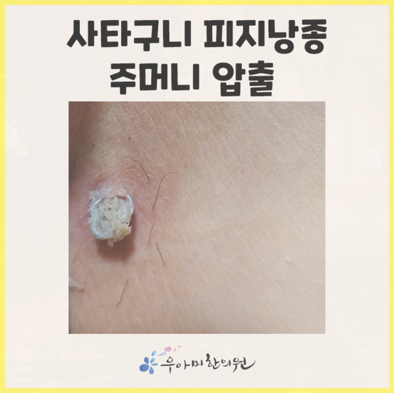 사타구니 피지낭종 병원 회음부 종기 어떻게 흉터 없이 해결할까?