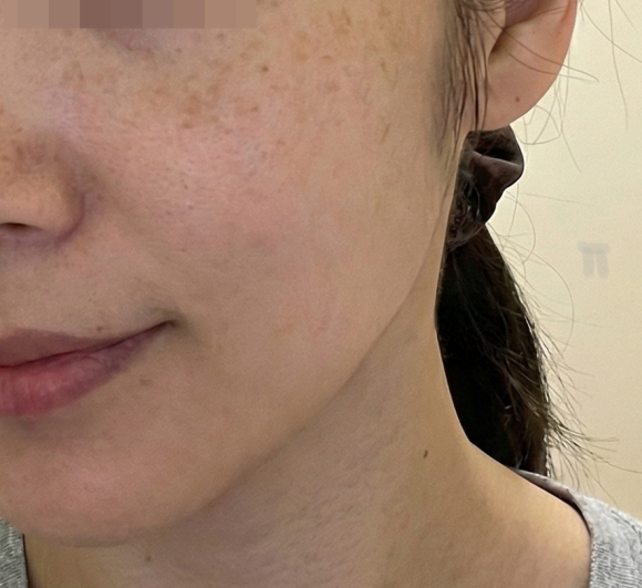 멜라논크림 <b>동아제약</b> 처방 후 기미관리후기