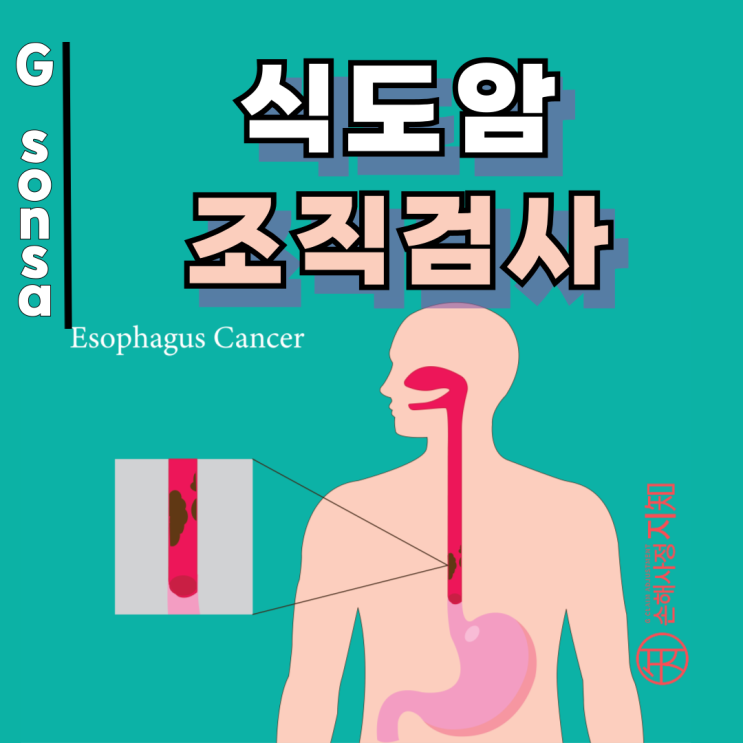  식도암 조직검사 - 암진단비 100% 받는 침윤 핵심 포인트