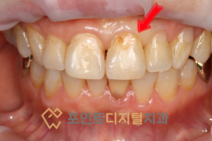  [탕정치과]  레진 재치료 후 1년 관찰 / 천안 아산