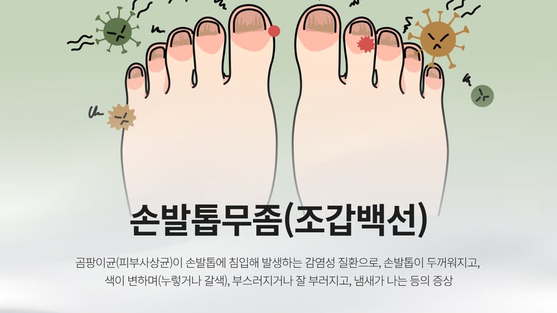 손발톱무좀 전염성 얼굴에도 옮을 수 있을까?