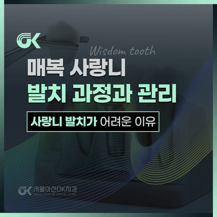  하남사랑니, 매복사랑니발치의 중요성