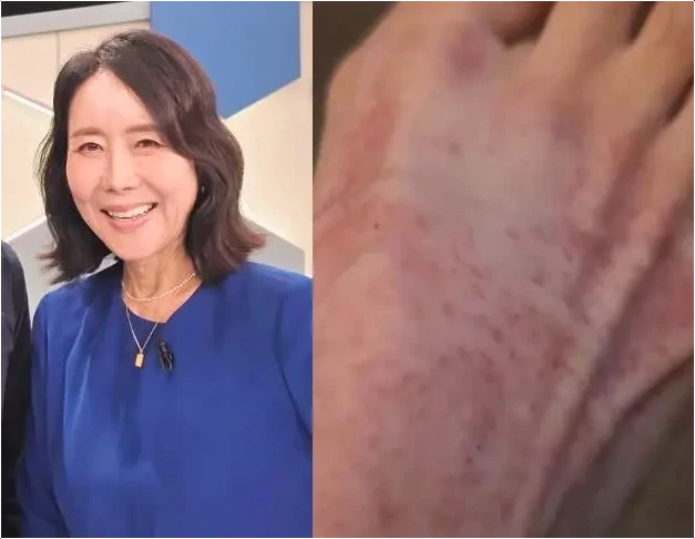  윤영미 유통기한 지난 화장품 사용한, 발등 붉은 발진 왜 생겼을까? 안전한 사용 기간과 보관법!