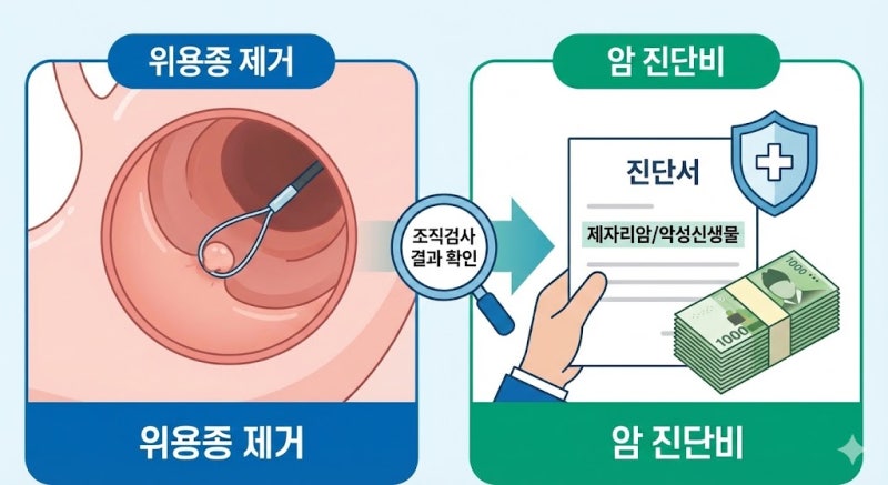 위용종 제거 D13.1 진단받았다면? '제자리암 진단비' 받을 수 있는 가능성 총정리!
