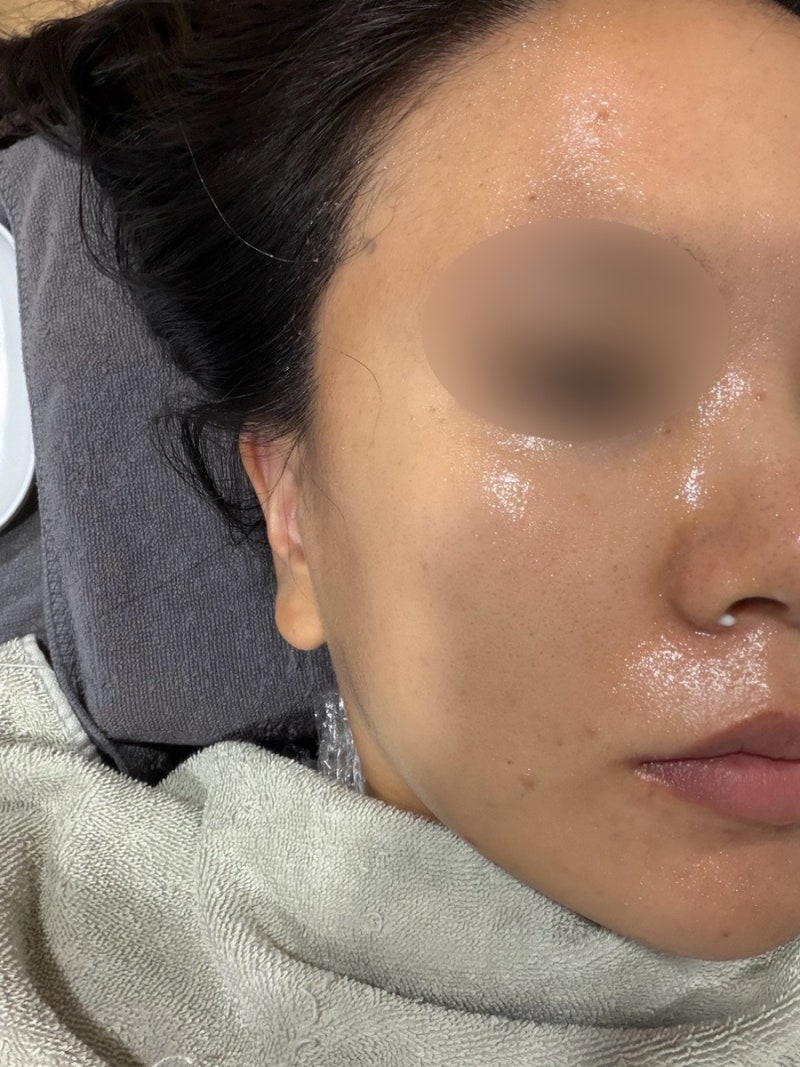 성남 편평사마귀, 개당 1000원 내돈내산 제거 당일 후기(사진 주의)