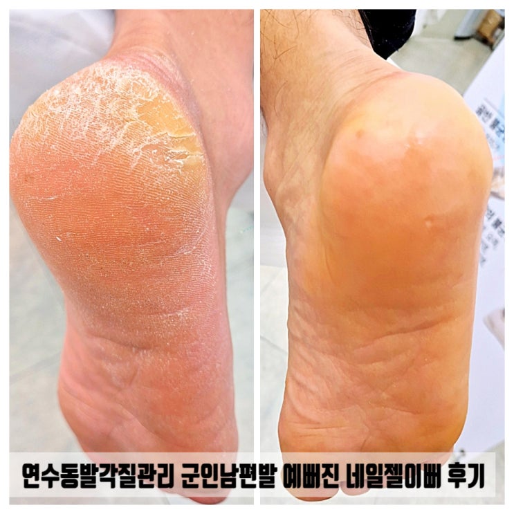  연수동발각질관리 군인남편발 예뻐진 네일젤이뻐 후기