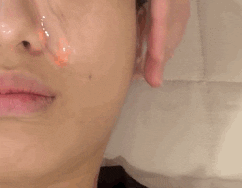 Suji Acne Management: Solve Your Acne Problems at Aemong Skincare with an Experienced Dermatologist