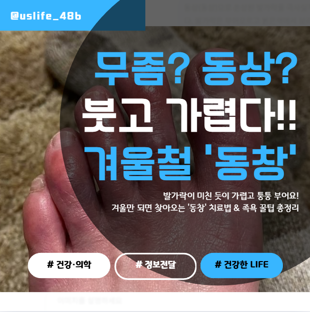 발가락이 간질간질 퉁퉁 부었다면? 겨울철 '동창' 증상 & 연고 추천 (동상 아님 주의)