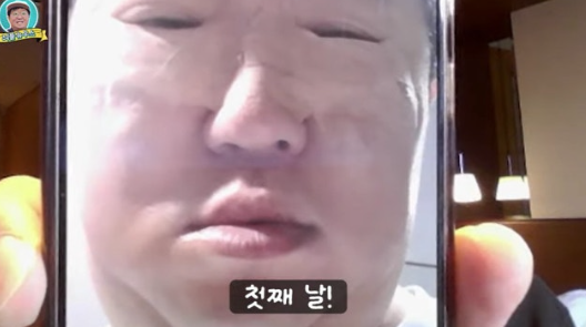   정형돈, 성형 직후 '퉁퉁 부은 눈' 공개! “일주일은 밖에 못 나가요” 진짜 대박!