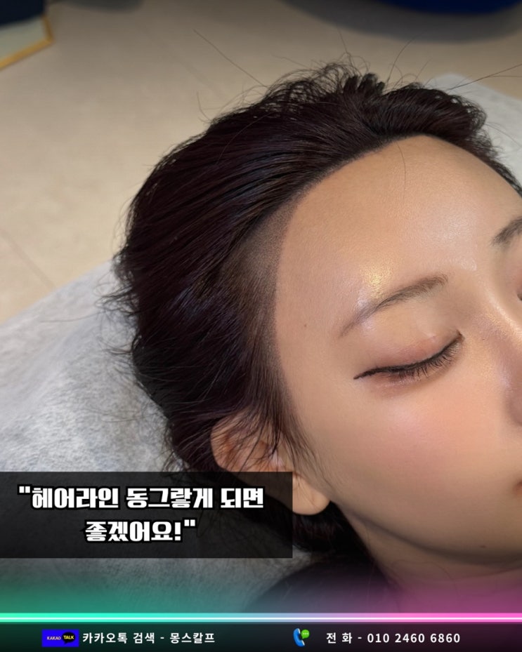  M자이마? 넓은이마? 이제 헤어라인문신으로 작아지자!