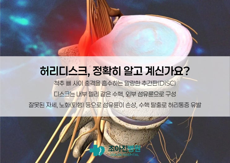  L-DISQ 엘디스큐 | 허리디스크 비수술 치료 A to Z