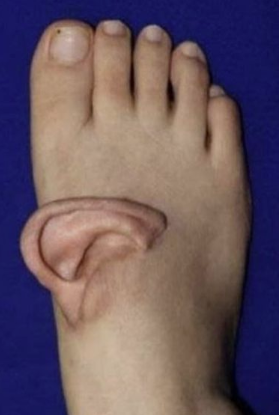   “발등에 귀가 붙었다고?!” 5개월 동안 발등에 귀 달고 다닌 중국 여성의 놀라운 재건 수술 이야기!