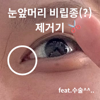 눈 앞머리 비립종인 줄 알았는데 수술 엔딩(낭종)