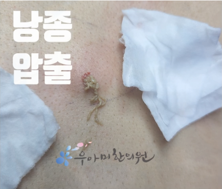 엉덩이 종기 피지낭종 표피낭종 혹 원인 연고 고약 문제점, 압출 제거 치료