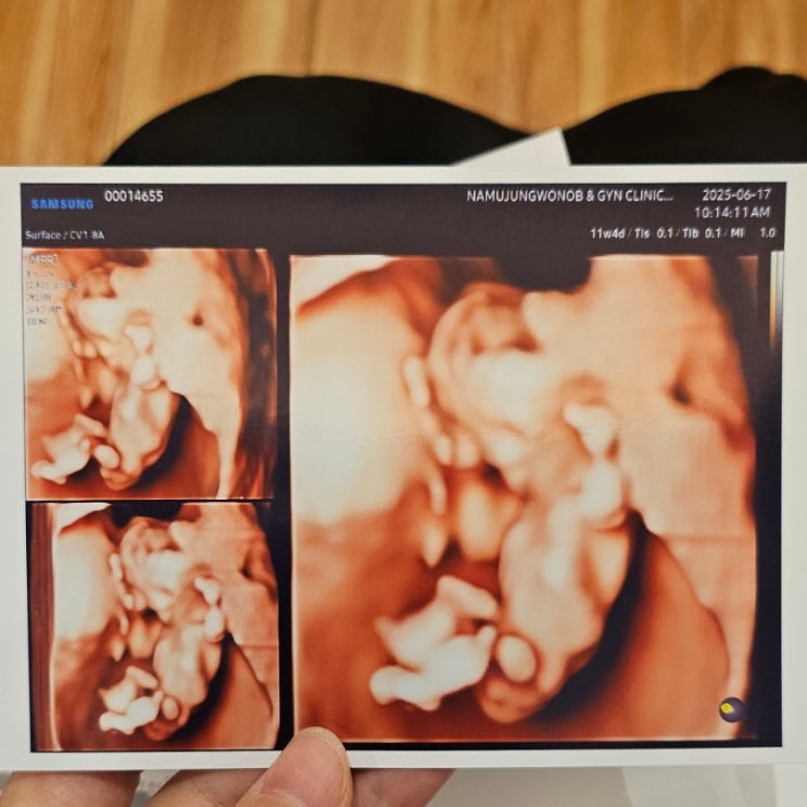  임신일기 | 임신초기 11주, 12주, 13주, 14주, 15주 기록 병원 진료 기형아 검사 첫 태동