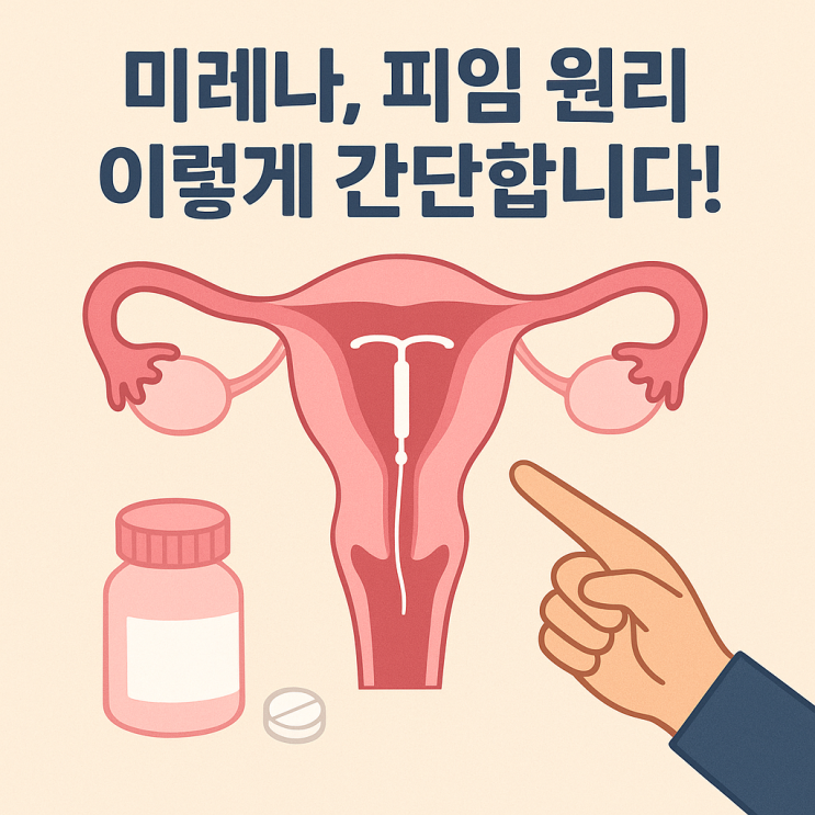  미레나란 무엇인가? 호르몬 IUD의 기본 원리, 한 번에 이해하기