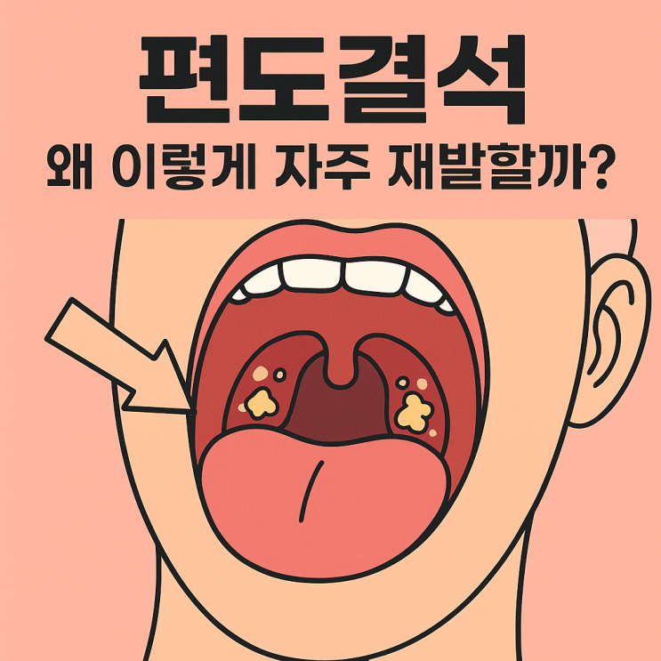  편도결석 재발이 잦은 이유와 관리 포인트｜왜 계속 생길까?