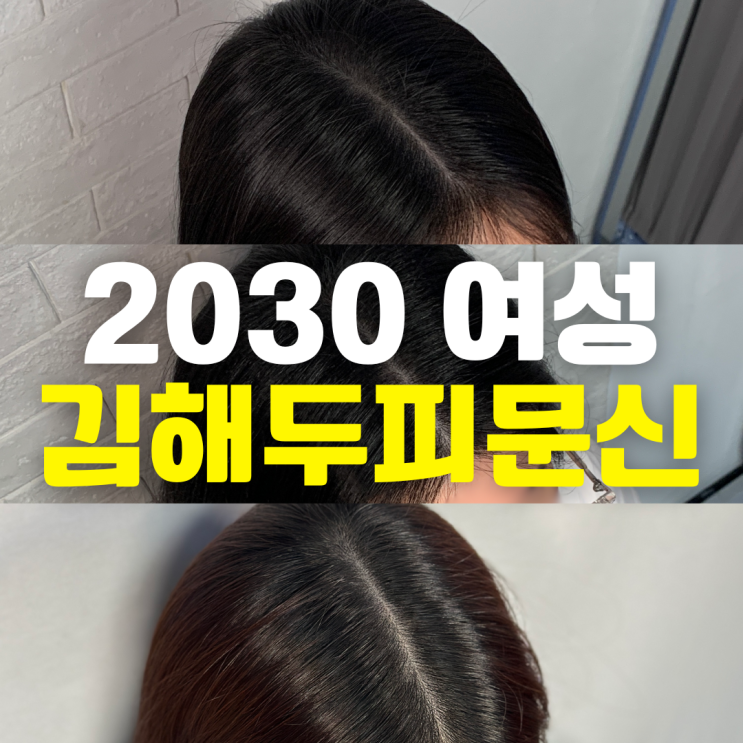  2030여성 가르마 탈모 고민, 김해두피문신으로 자연스럽게 해결한 리얼 후기!