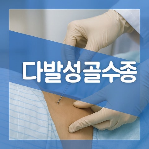 다발성 골수종 예후 증상, 다발골수동 항암 치료 방법