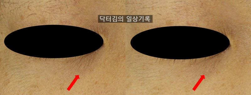 눈밑 잔주름 제거, 레이저 스킨부스터 시술 및 관리 방법 [by 피부과 전문의 닥터킴]