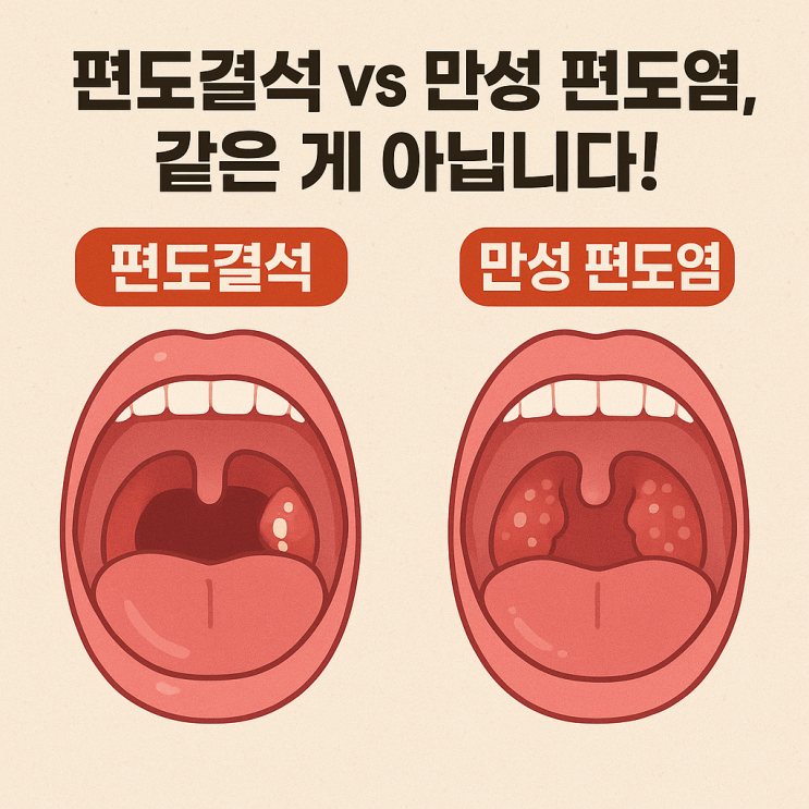  편도결석과 만성 편도염의 차이와 연결고리｜헷갈리기 쉬운 두 질환의 진짜 관계