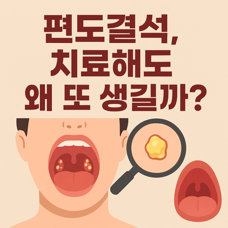  편도결석 치료 후 재발률은 얼마나 될까? 치료 방법별 차이까지 한 번에 정리