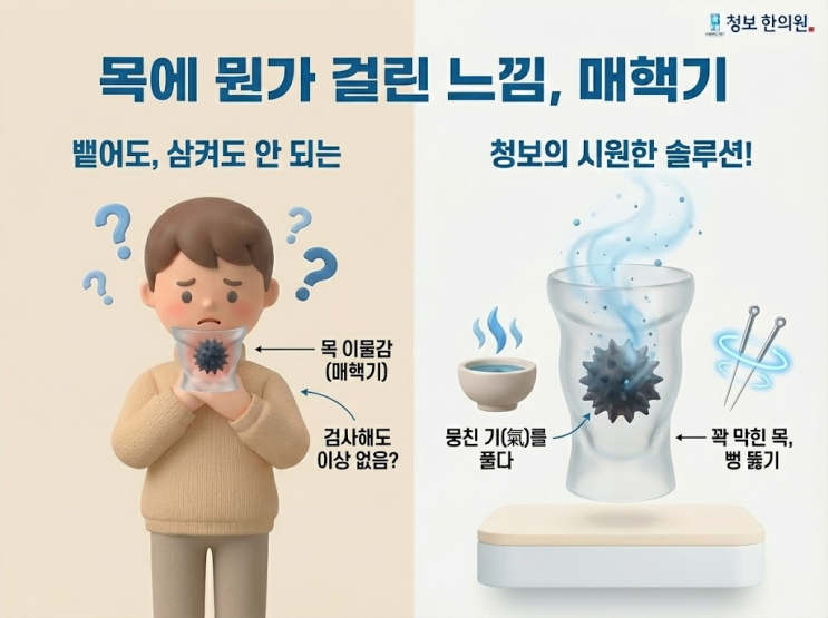  목에 무언가 걸린 느낌, 뱉어도 나오지 않는 '매핵기'