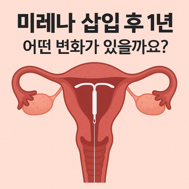  미레나 삽입 후 1년 변화 타임라인: 어떤 변화가 있을까요? 